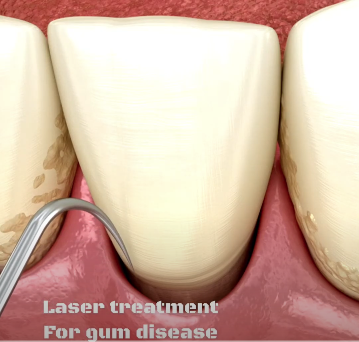Laser Treatment for Gum Disease