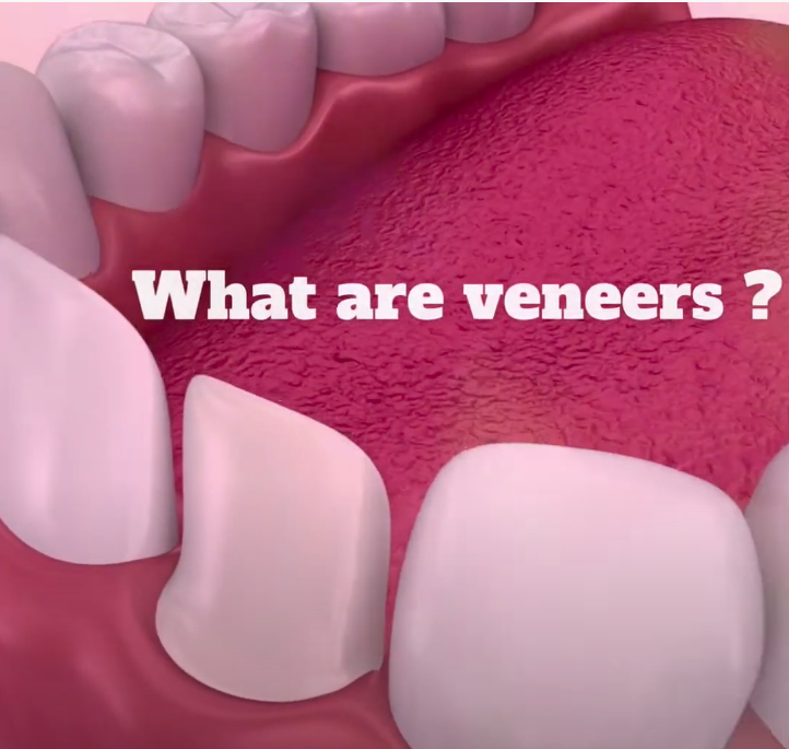 What are Veneers?