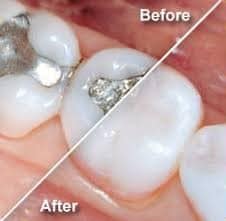 Tooth-Colored Filling