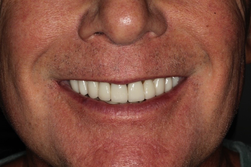 Veneers