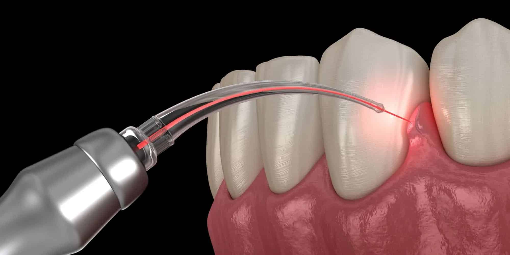 LANAP: The Only FDA-Approved Laser Proven to Regenerate Bone & Treat Gum Disease