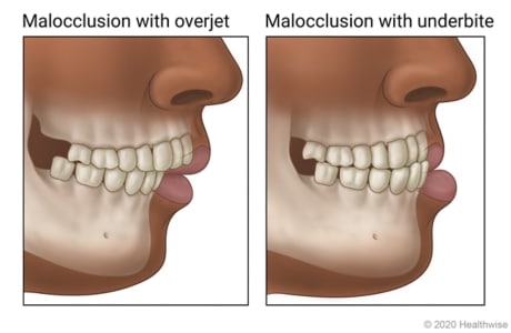 What Is Malocclusion? Signs, Symptoms, and Why Treatment Matters