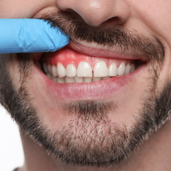 LANAP Gum Surgery: A Minimally Invasive Breakthrough in Treating Gum Disease (which is directly affecting heart disease !)