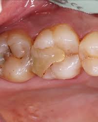 Inlays and Onlays vs. Composite Fillings: What’s the Difference?