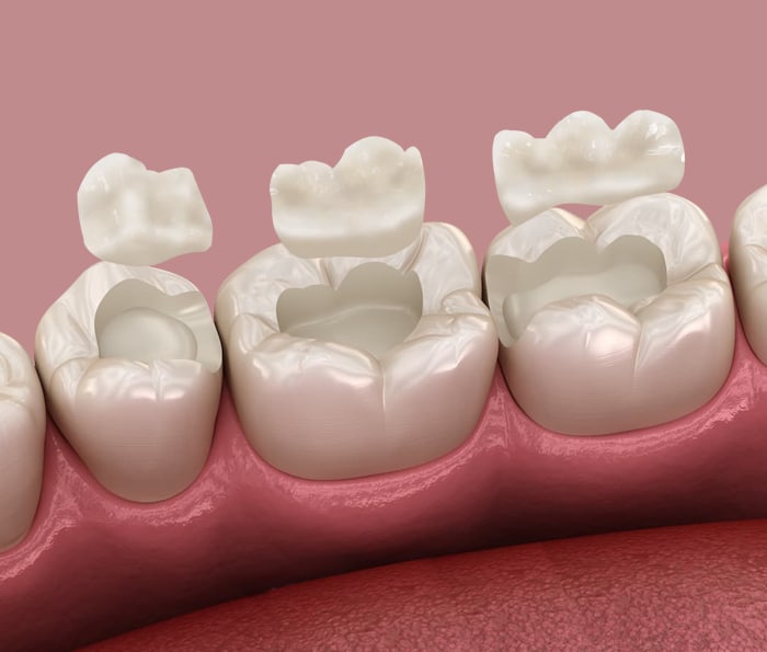 Inlays and Onlays vs. Composite Fillings: What’s the Difference?