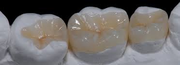 Inlays and Onlays vs. Composite Fillings: What’s the Difference?