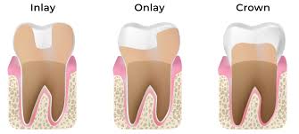 Inlays and Onlays vs. Composite Fillings: What’s the Difference?