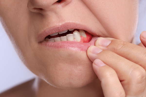 Can Gum Disease Be Reversed? Gum Disease Treatment Options in Sarasota, FL
