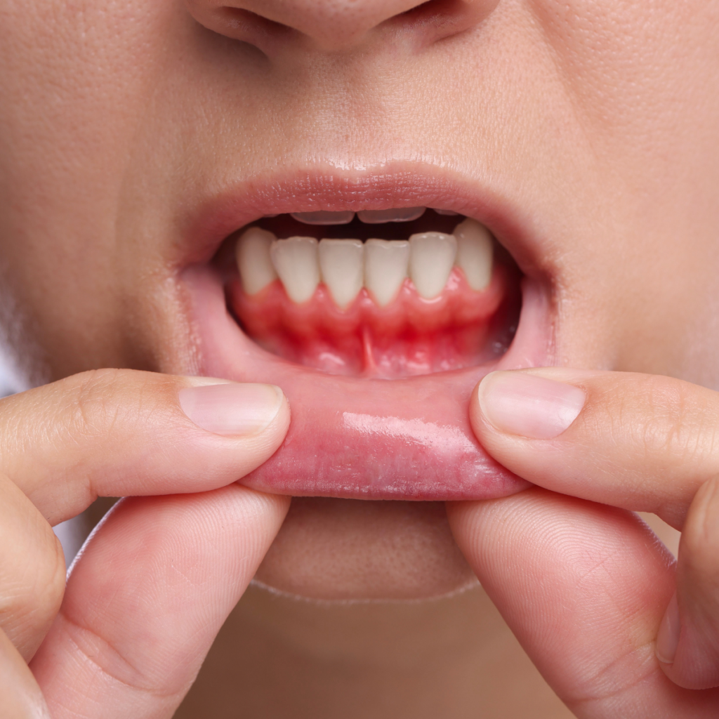 5 Signs You May Have Gum Disease (And Why Early Treatment Matters)​