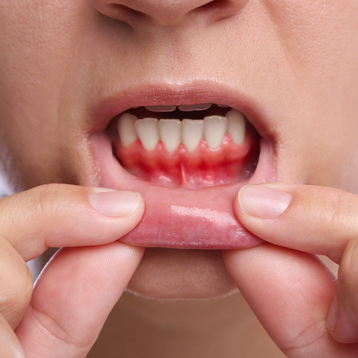 5 Signs You May Have Gum Disease (And Why Early Treatment Matters)​