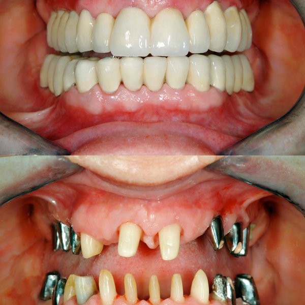 Can Full Mouth Reconstruction Improve Your Bite and Jaw Comfort?