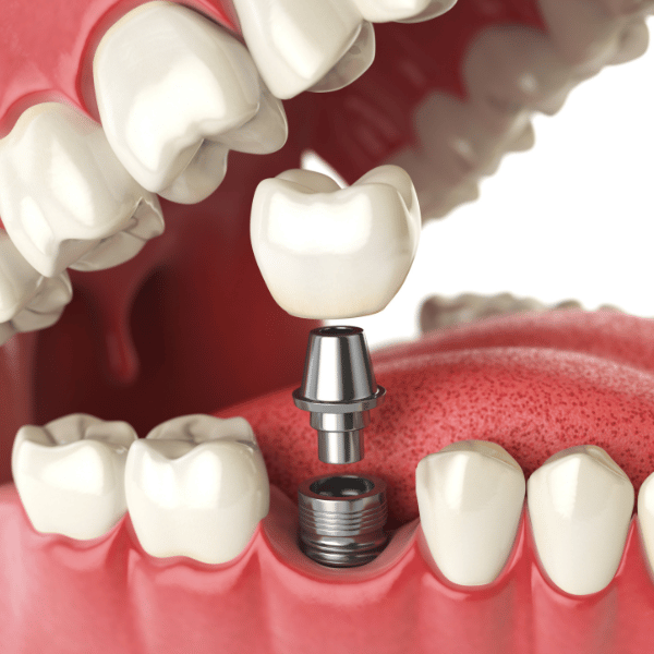 Dental Implants vs. Bridges: Which Is Better for Missing Teeth?