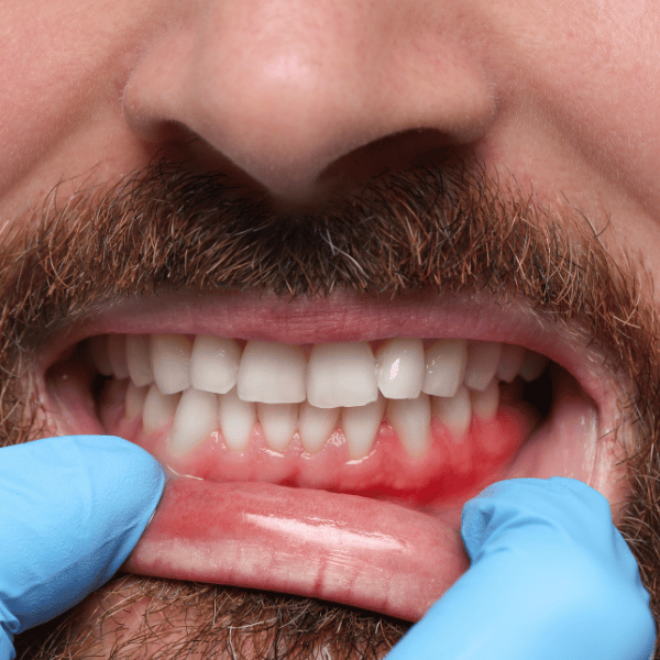 Gum Health and Heart Health: How LANAP Laser Gum Treatment in Sarasota Helps Treat Gum Disease